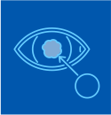 Cataract